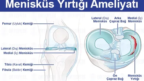 Menisküs Yırtığı: Belirtileri ve Tedavi Süreci