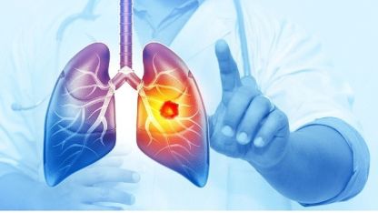 Her Yıl 25 Bin Akciğer Kanseri Vakası Önlenebilir